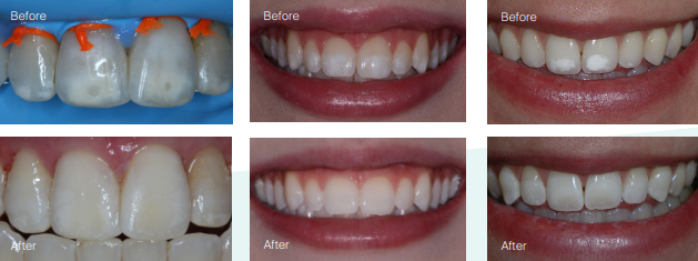Icon Resin Infiltration Before and After